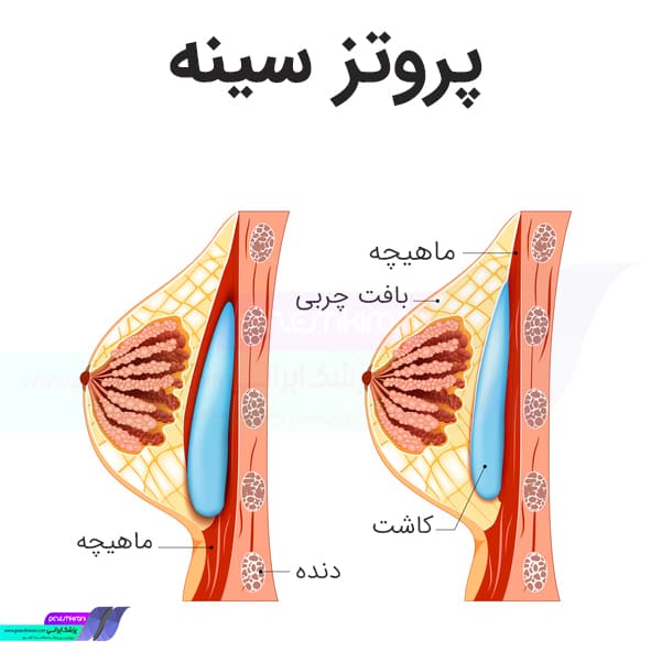چگونگی انجام پروتز سینه
