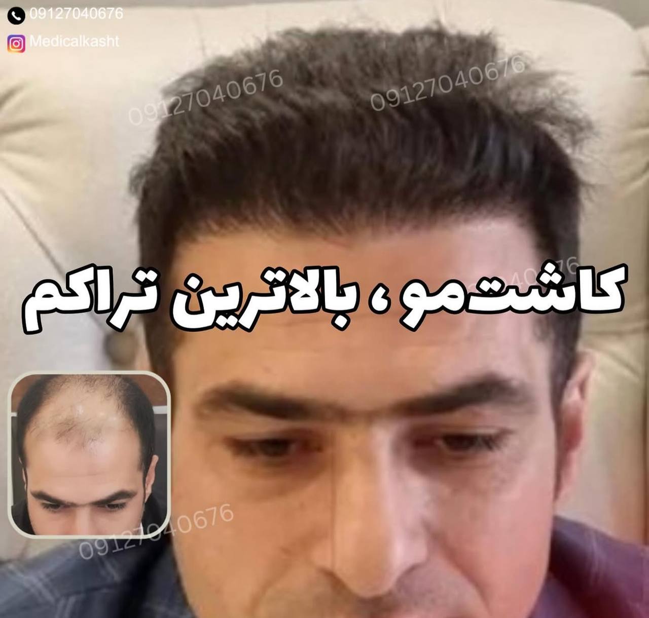 بالاترین ترام کاشت مو